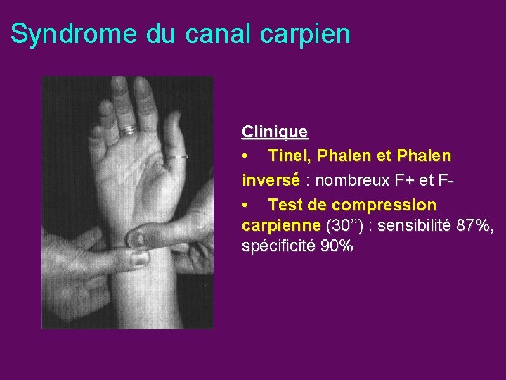 Syndrome du canal carpien Clinique • Tinel, Phalen et Phalen inversé : nombreux F+