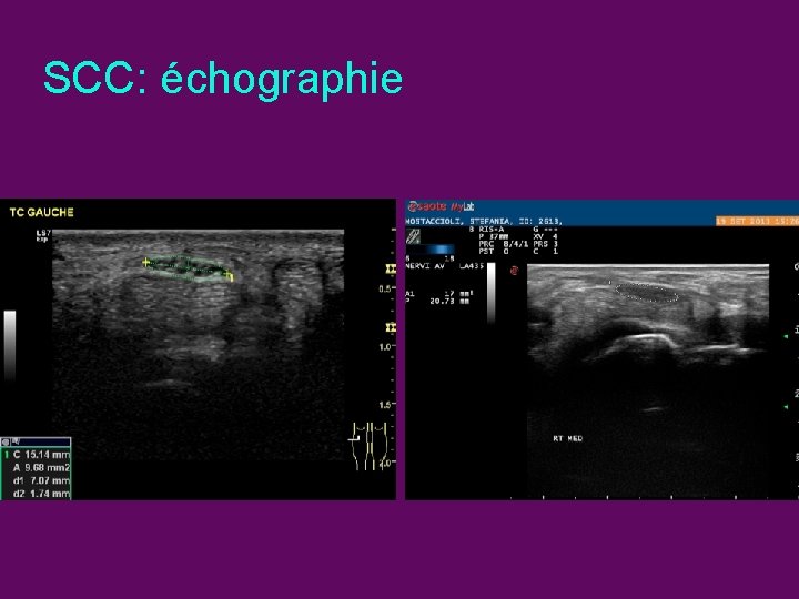 SCC: échographie 