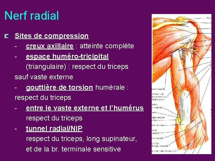 Nerf radial Sites de compression - creux axillaire : atteinte complète - espace huméro-tricipital