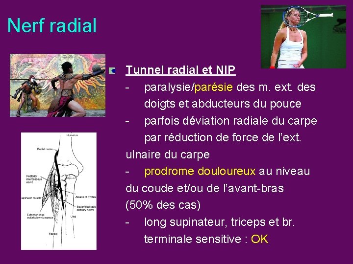 Nerf radial Tunnel radial et NIP - paralysie/parésie des m. ext. des doigts et