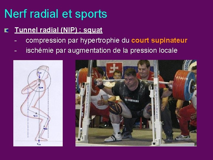 Nerf radial et sports Tunnel radial (NIP) : squat - compression par hypertrophie du