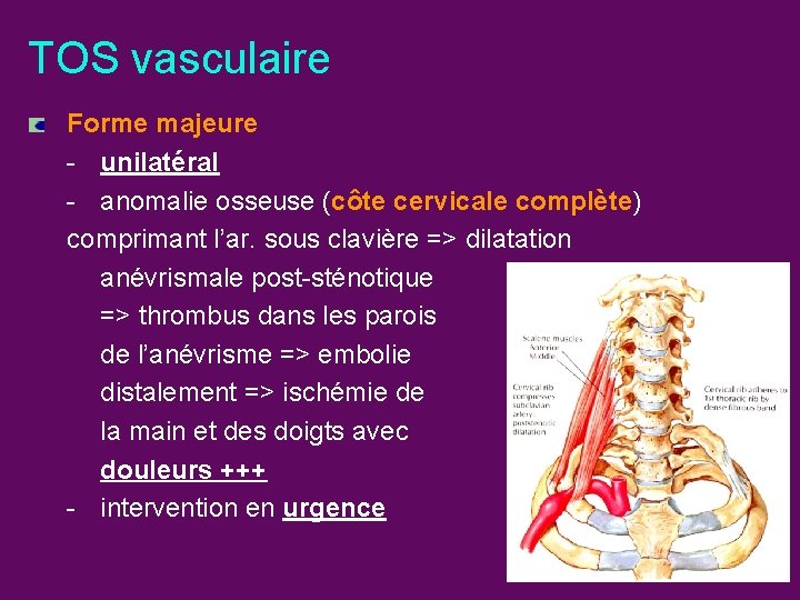 TOS vasculaire Forme majeure - unilatéral - anomalie osseuse (côte cervicale complète) comprimant l’ar.