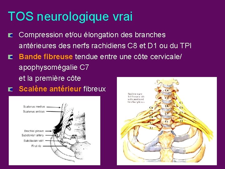 TOS neurologique vrai Compression et/ou élongation des branches antérieures des nerfs rachidiens C 8