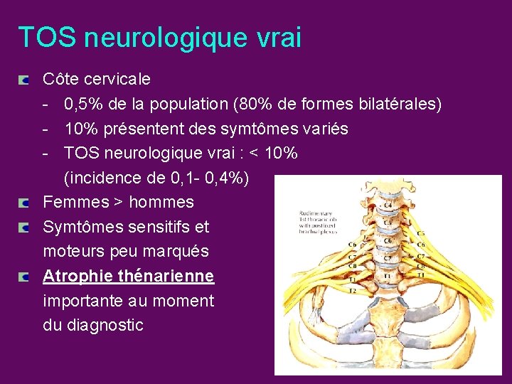 TOS neurologique vrai Côte cervicale - 0, 5% de la population (80% de formes