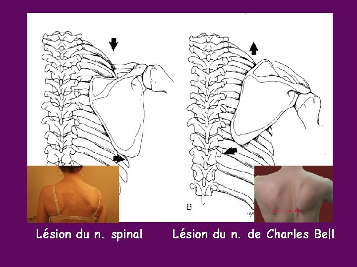 Lésion du n. spinal Lésion du n. de Charles Bell 
