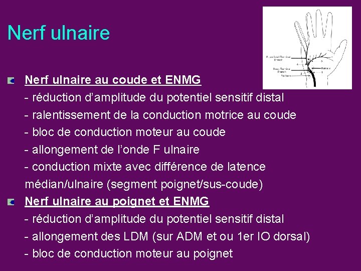 Nerf ulnaire au coude et ENMG - réduction d’amplitude du potentiel sensitif distal -