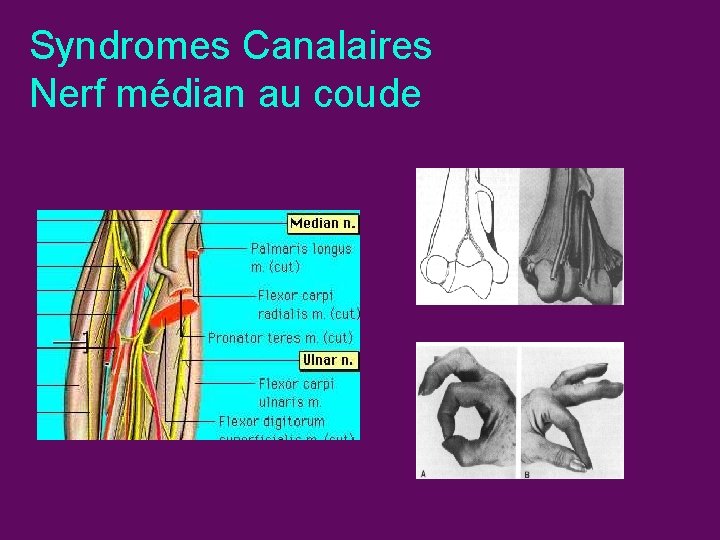 Syndromes Canalaires Nerf médian au coude 