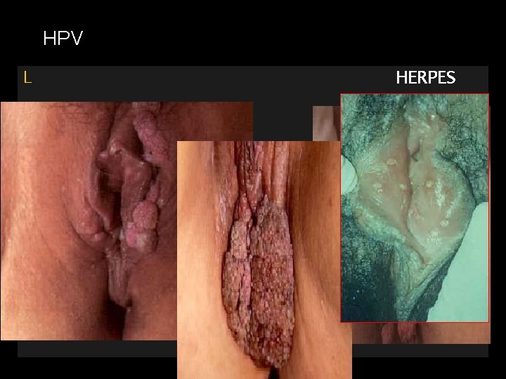 HPV L HERPES 