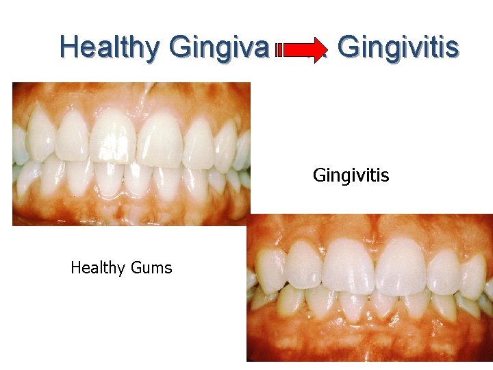 Healthy Gingiva . . . Gingivitis Healthy Gums 