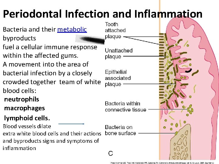 Periodontal Infection and Inflammation Bacteria and their metabolic byproducts fuel a cellular immune response
