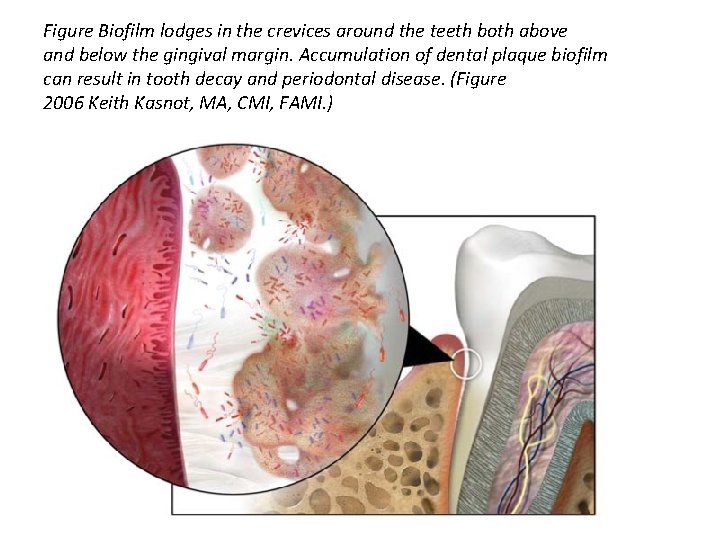 Figure Biofilm lodges in the crevices around the teeth both above and below the