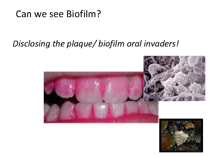 Can we see Biofilm? Disclosing the plaque/ biofilm oral invaders! 