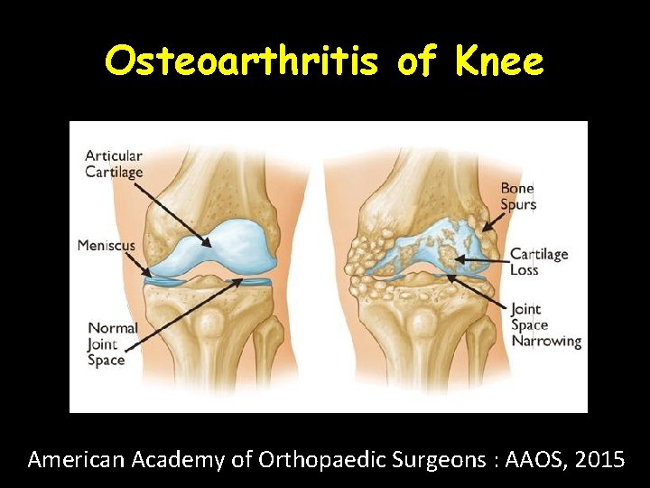 Osteoarthritis of Knee American Academy of Orthopaedic Surgeons : AAOS, 2015 