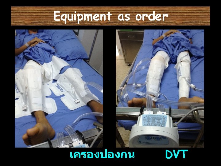Equipment as order เครองปองกน DVT 