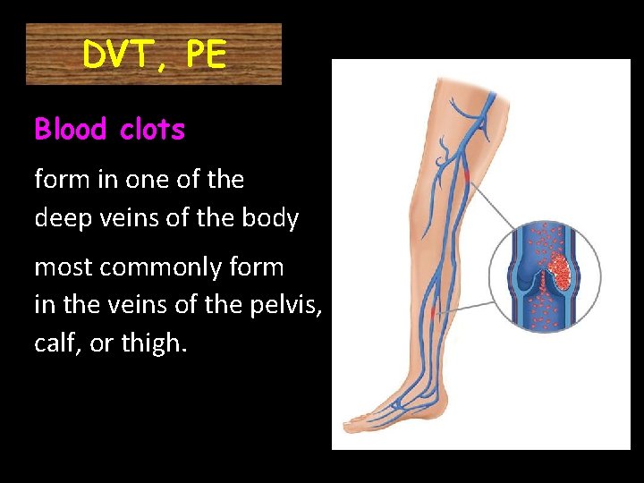 DVT, PE Blood clots form in one of the deep veins of the body