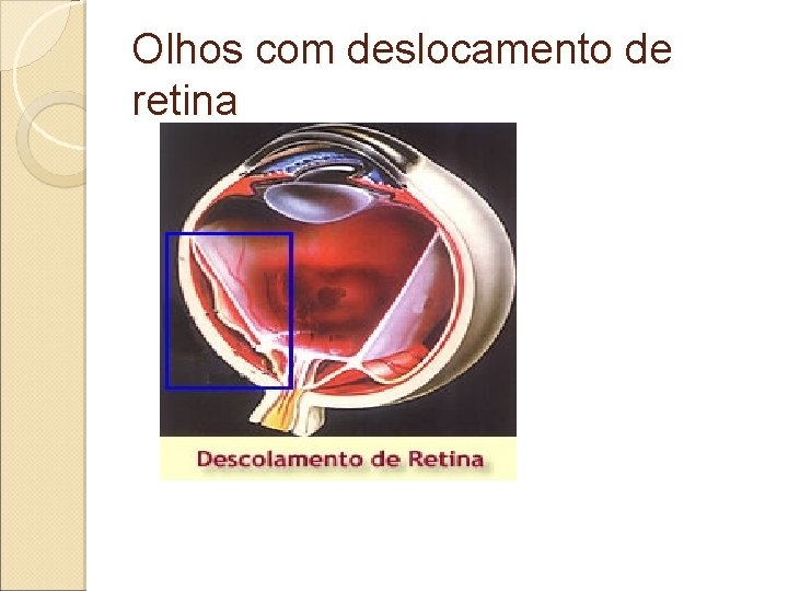 Olhos com deslocamento de retina Olhos com deslocamento de retina
