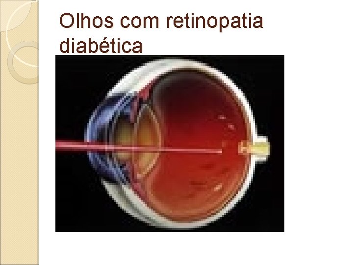 Olhos com retinopatia diabética Olhos com retinopatia diabética