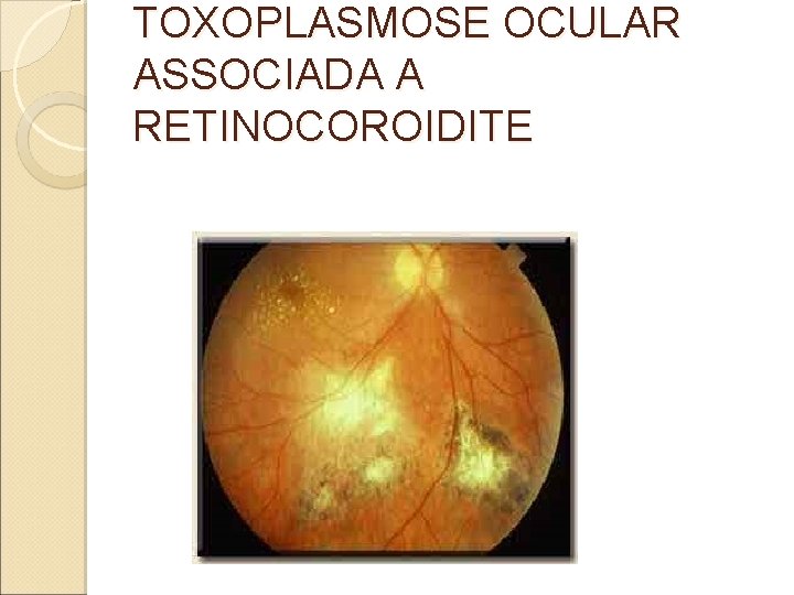TOXOPLASMOSE OCULAR ASSOCIADA A RETINOCOROIDITE TOXOPLASMOSE OCULAR ASSOCIADA A RETINOCOROIDITE