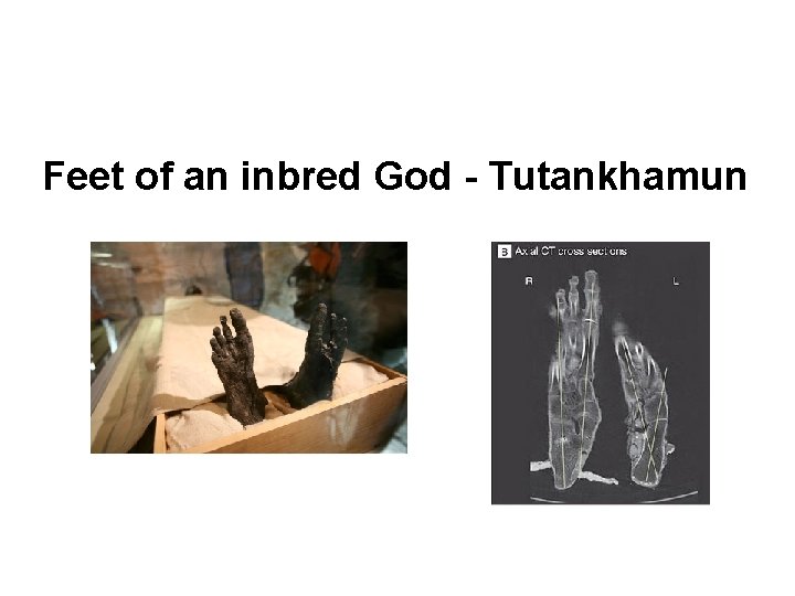 Feet of an inbred God - Tutankhamun 