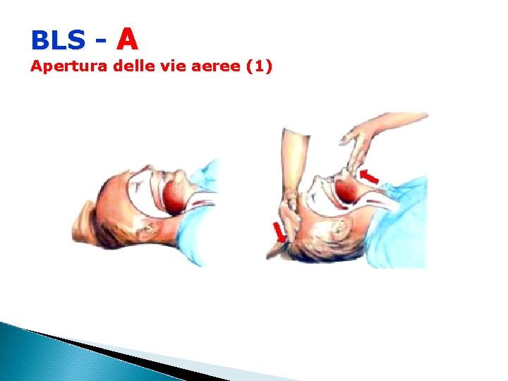 BLS - A Apertura delle vie aeree (1) 