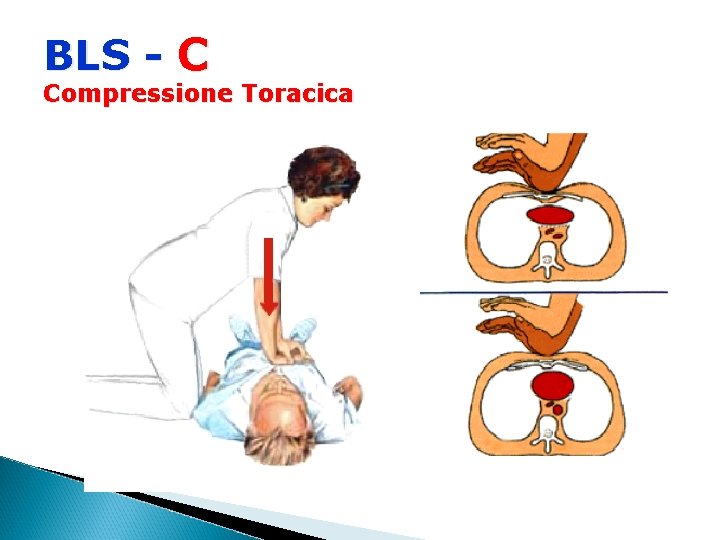 BLS - C Compressione Toracica 