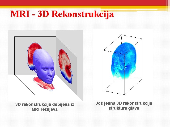 MRI - 3 D Rekonstrukcija 3 D rekonstrukcija dobijena iz MRI režnjeva Još jedna