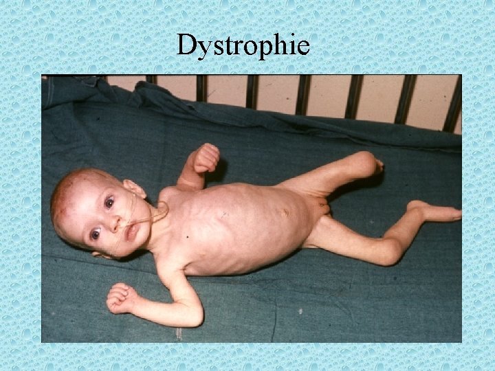 Dystrophie 
