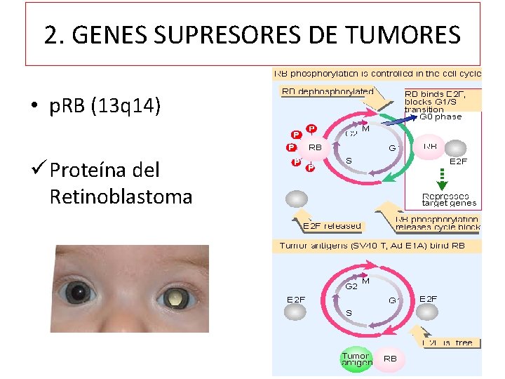 2. GENES SUPRESORES DE TUMORES • p. RB (13 q 14) ü Proteína del
