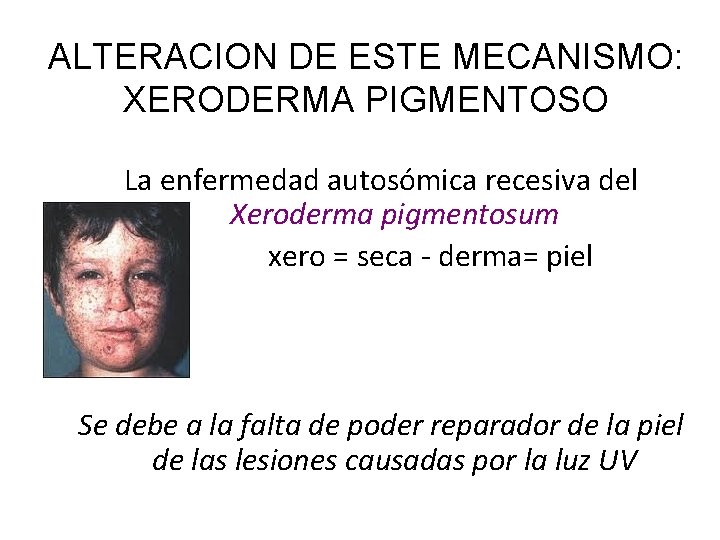 ALTERACION DE ESTE MECANISMO: XERODERMA PIGMENTOSO La enfermedad autosómica recesiva del Xeroderma pigmentosum xero