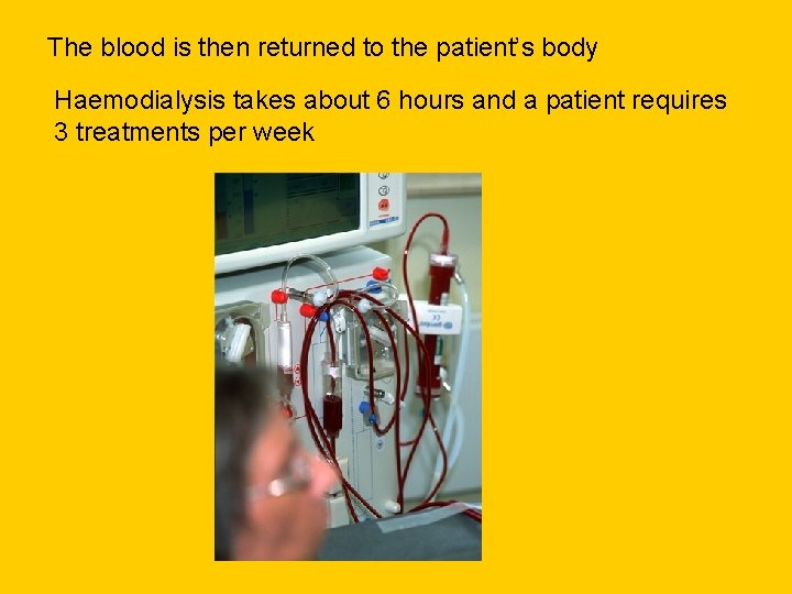 The blood is then returned to the patient’s body Haemodialysis takes about 6 hours