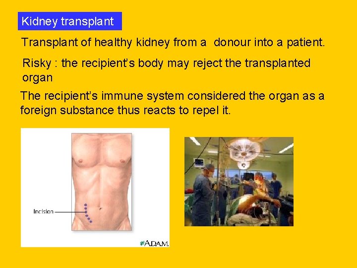 Kidney transplant Transplant of healthy kidney from a donour into a patient. Risky :