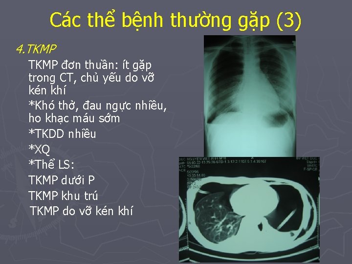 Các thể bệnh thường gặp (3) 4. TKMP đơn thuần: ít gặp trong CT,