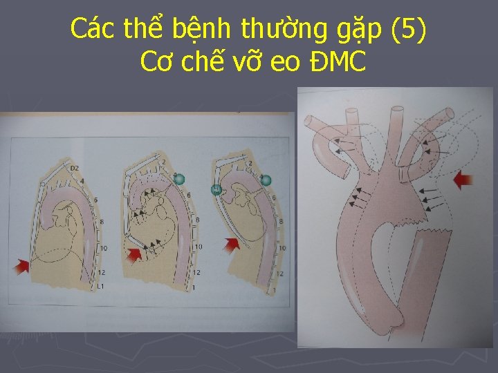 Các thể bệnh thường gặp (5) Cơ chế vỡ eo ĐMC 