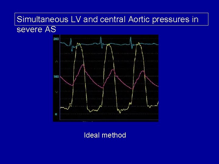 Simultaneous LV and central Aortic pressures in severe AS Ideal method 