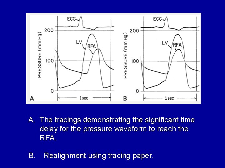 A. The tracings demonstrating the significant time delay for the pressure waveform to reach