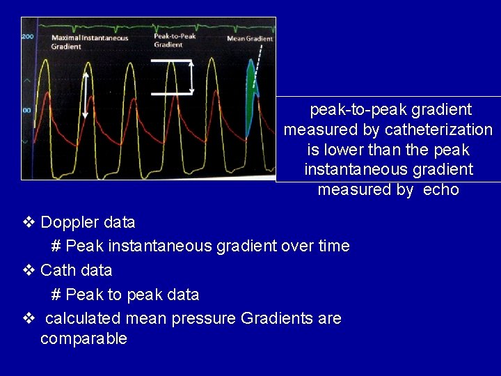  peak-to-peak gradient measured by catheterization is lower than the peak instantaneous gradient measured