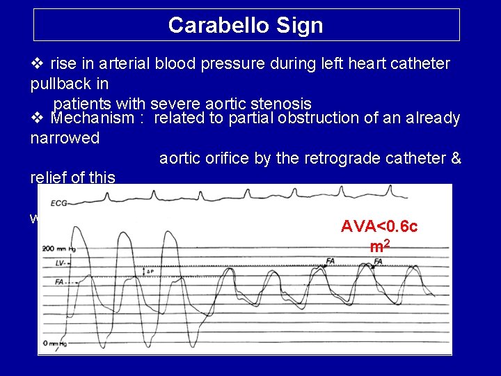 Carabello Sign v rise in arterial blood pressure during left heart catheter pullback in