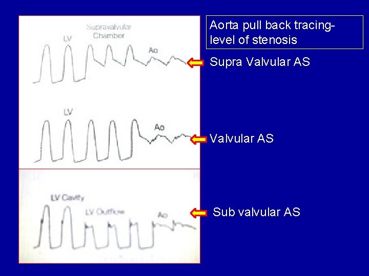 Aorta pull back tracing- level of stenosis Supra Valvular AS Sub valvular AS 