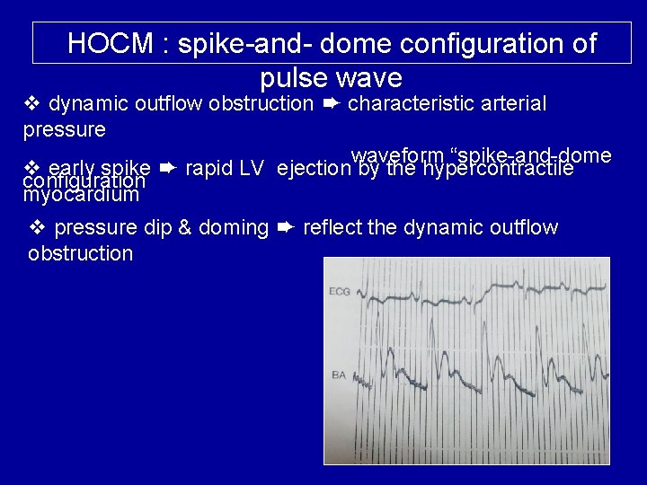 HOCM : spike-and- dome configuration of pulse wave v dynamic outflow obstruction ➨ characteristic