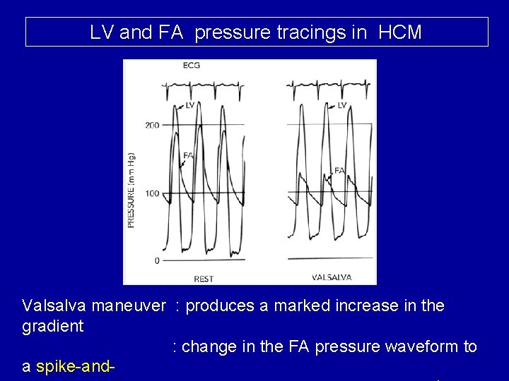LV and FA pressure tracings in HCM Valsalva maneuver : produces a marked increase