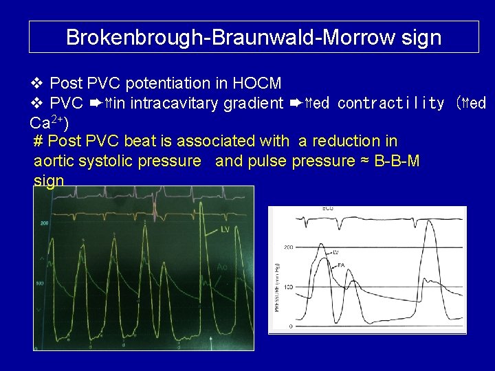 Brokenbrough-Braunwald-Morrow sign v Post PVC potentiation in HOCM v PVC ➨⇈in intracavitary gradient ➨⇈ed