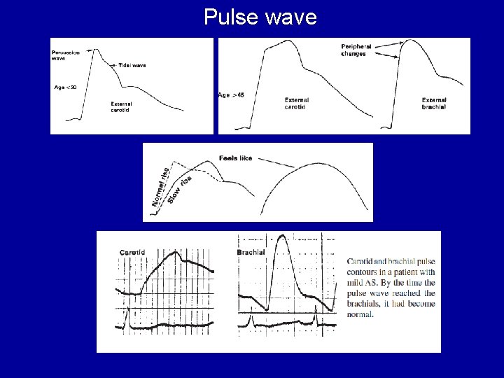 Pulse wave 