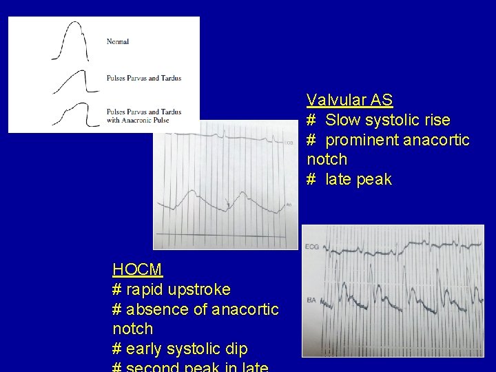 Valvular AS # Slow systolic rise # prominent anacortic notch # late peak HOCM