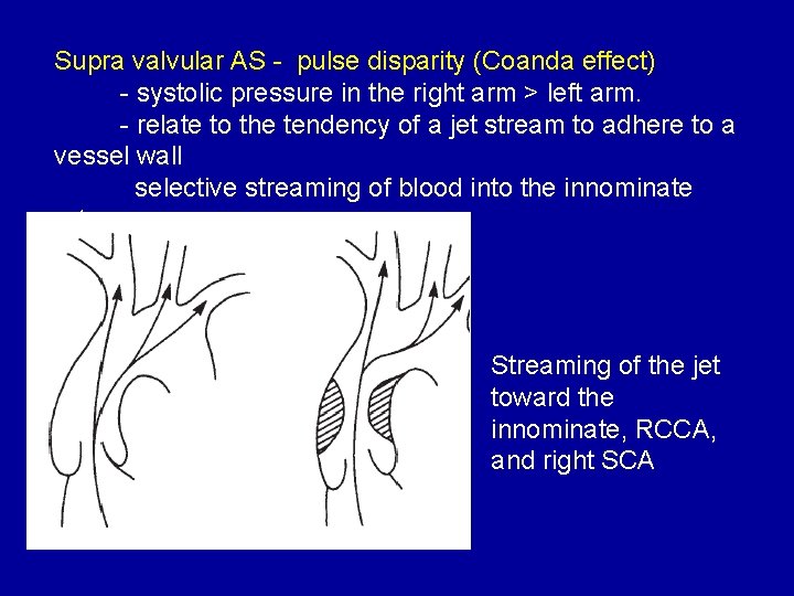 Supra valvular AS - pulse disparity (Coanda effect) - systolic pressure in the right