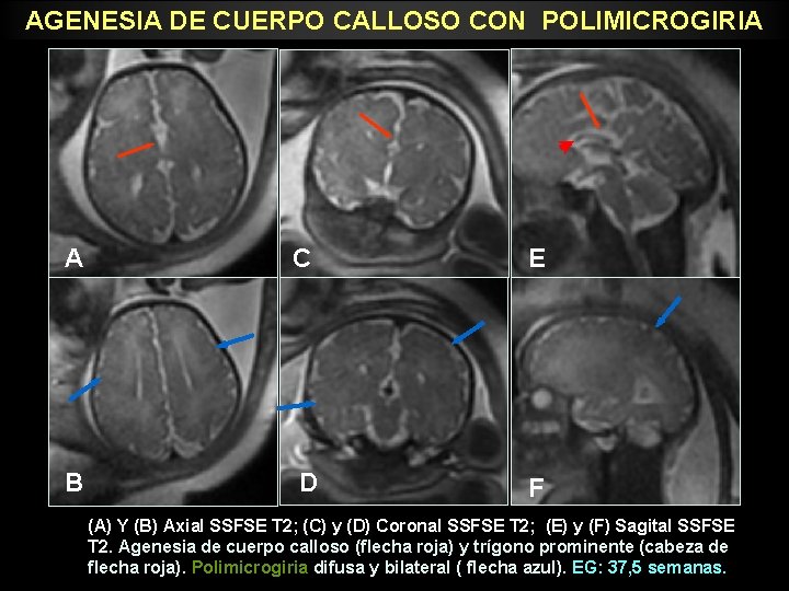 AGENESIA DE CUERPO CALLOSO CON POLIMICROGIRIA A C E B D F (A) Y