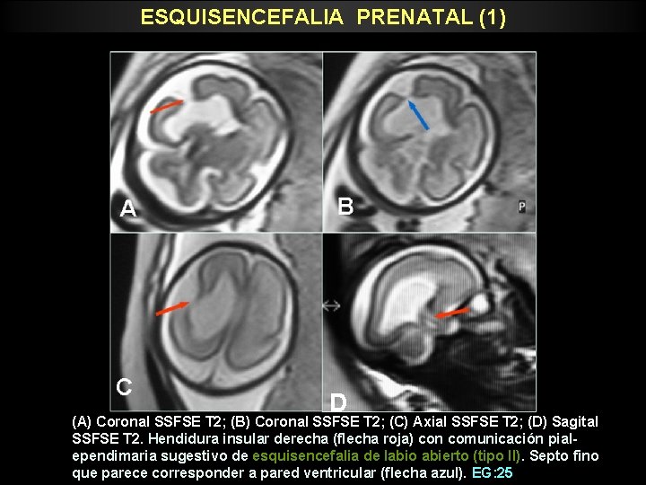 ESQUISENCEFALIA PRENATAL (1) D (A) Coronal SSFSE T 2; (B) Coronal SSFSE T 2;