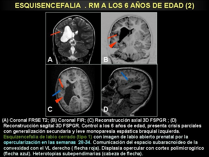 ESQUISENCEFALIA. RM A LOS 6 AÑOS DE EDAD (2) A B C D (A)