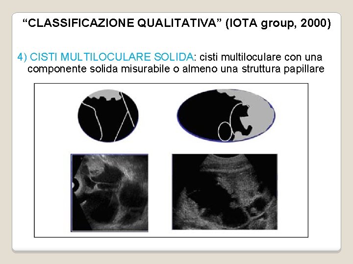 “CLASSIFICAZIONE QUALITATIVA” (IOTA group, 2000) 4) CISTI MULTILOCULARE SOLIDA: cisti multiloculare con una componente