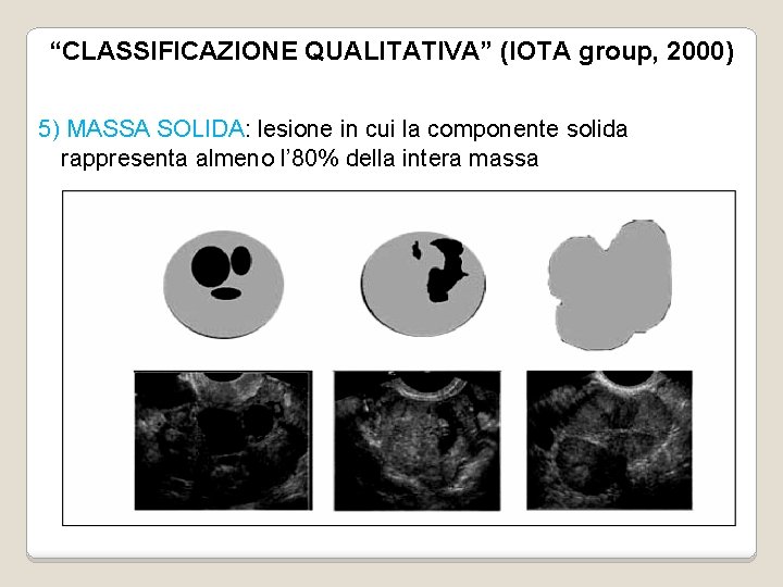 “CLASSIFICAZIONE QUALITATIVA” (IOTA group, 2000) 5) MASSA SOLIDA: lesione in cui la componente solida