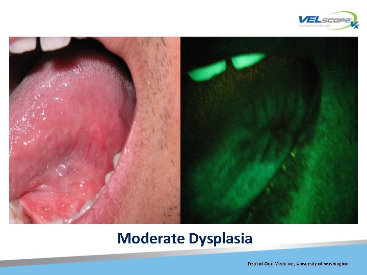 Moderate Dysplasia Dept of Oral Medicine, University of Washington 